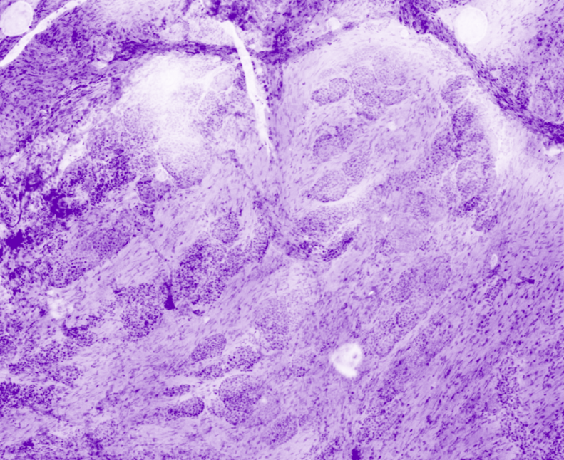 Prostatic glandular infiltrates